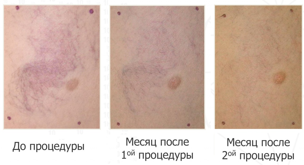 Лазерное удаление звездочек результаты фото 1